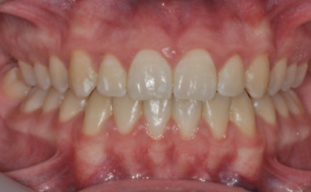 Pre-treatment - Intra oral views