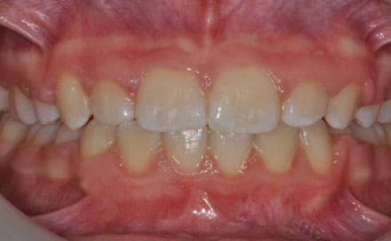 Pre-treatment - Intra oral views